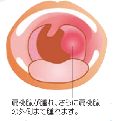 扁桃周囲炎・扁桃周囲膿瘍